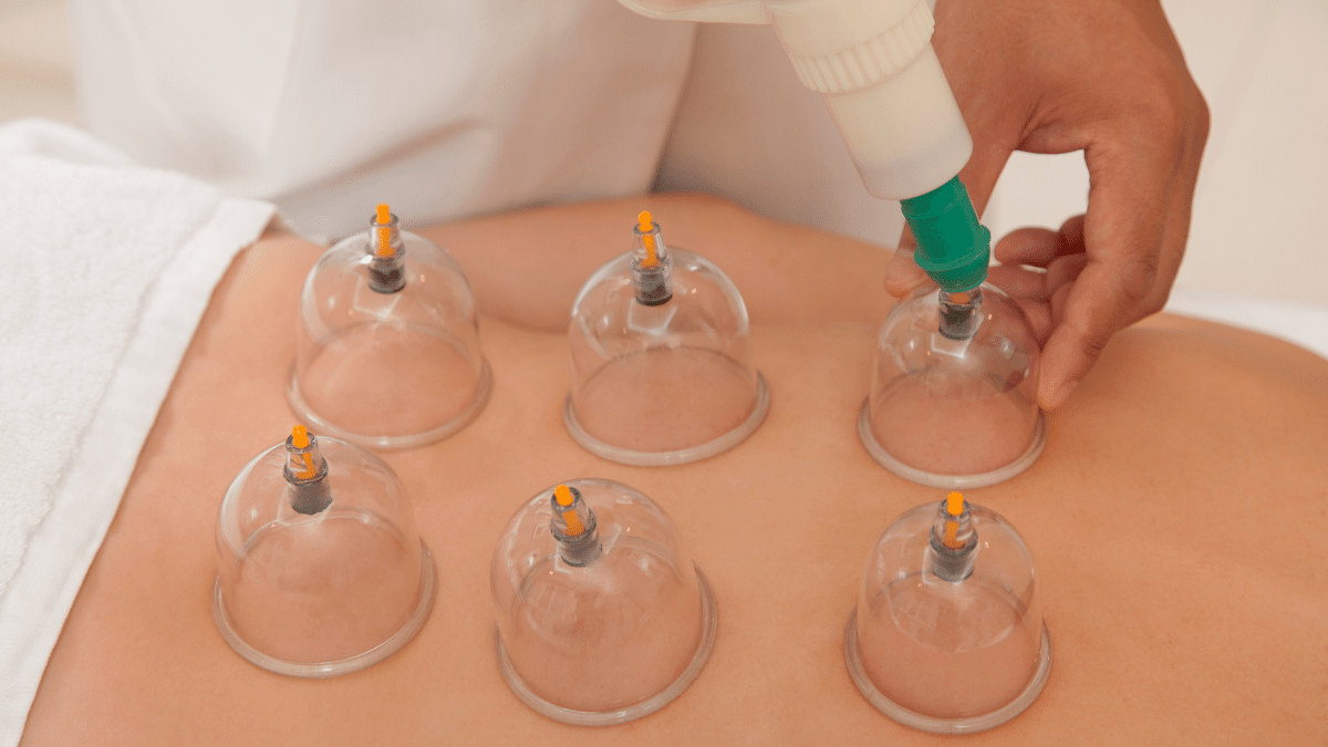 Cupping Therapy and Your Massage Practice